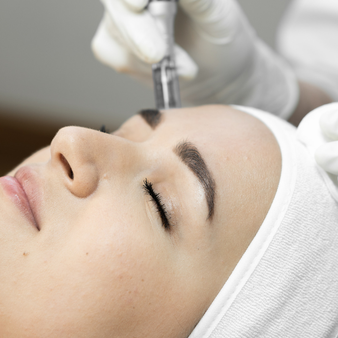 Microneedling: Everything you need to know